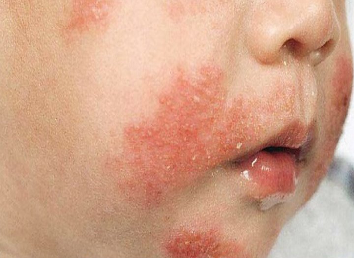 Cách nhận biết và xử lý dị ứng trứng gà ở trẻ em cha mẹ cần lưu ý