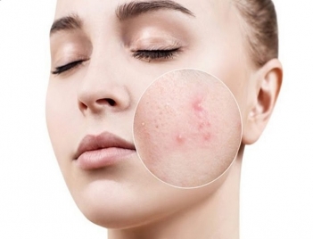 Vì sao uống collagen bị nổi mụn và cách khắc phục? - Sức khỏe & Môi trường